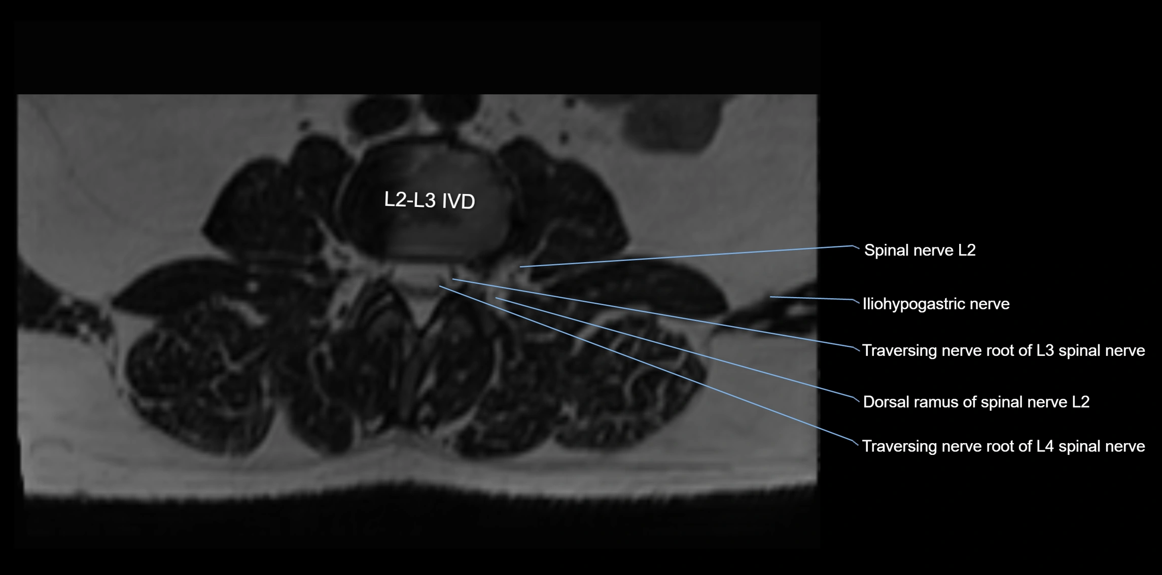 MR lumbosacral plexus axial cross sectional anatomy 3T  radiology  image-img-1008001-00014.webp